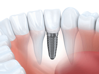 Porcelain Crowns Brighton Dental Offic