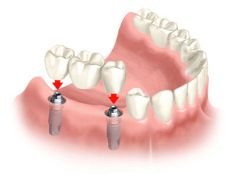 porcelain fixed bridges brighton beach dentist best dentist 2017 11235 broitman dds