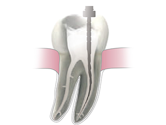 dental bridge - fixed bridge